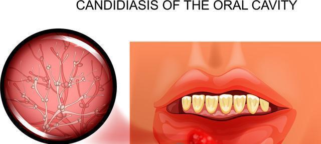 口腔溃疡的7个快速疗法（自救秘笈让你迅速摆脱口腔溃疡困扰）  第1张