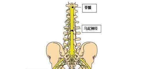 坐骨神经痛的症状有哪些？如何选择合适的治疗方法？  第3张